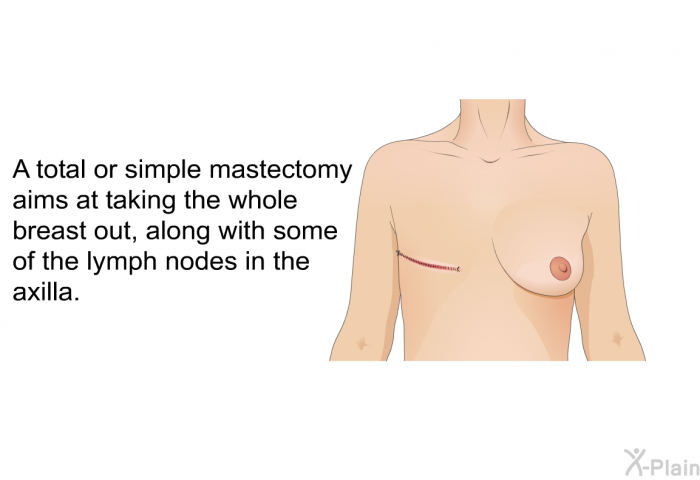 A total or simple mastectomy aims at taking the whole breast out, along with some of the lymph nodes in the axilla.