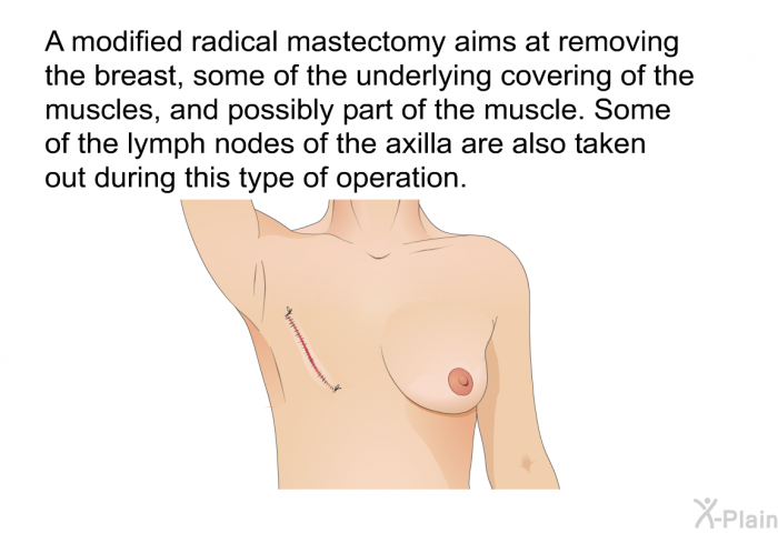 A modified radical mastectomy aims at removing the breast, some of the underlying covering of the muscles, and possibly part of the muscle. Some of the lymph nodes of the axilla are also taken out during this type of operation.