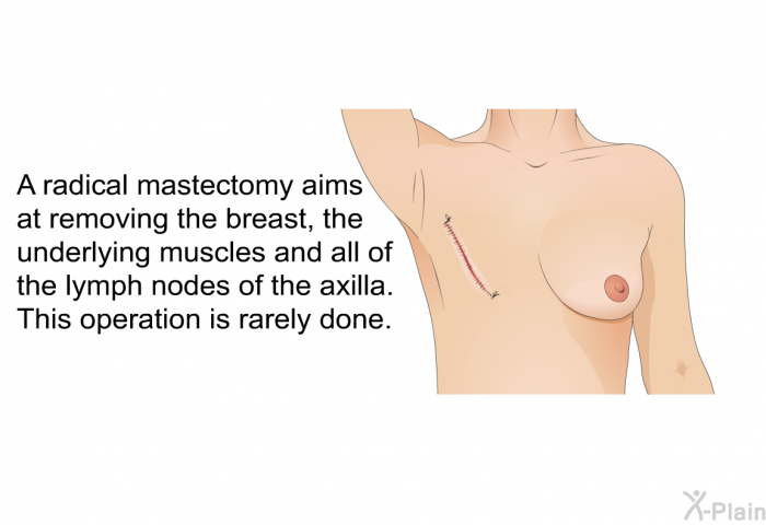 A radical mastectomy aims at removing the breast, the underlying muscles and all of the lymph nodes of the axilla. This operation is rarely done.