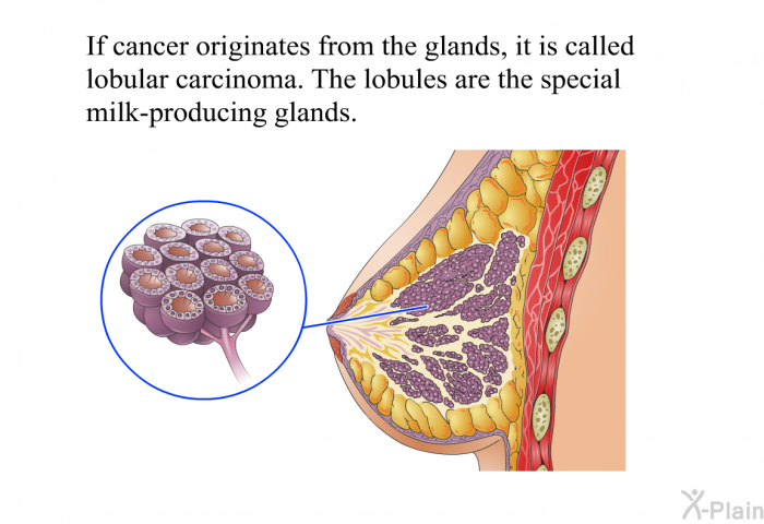 If cancer originates from the glands, it is called lobular carcinoma. The lobules are the special milk-producing glands.