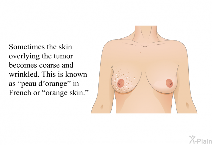 Sometimes the skin overlying the tumor becomes coarse and wrinkled. This is known as &ldquo;peau d'orange&rdquo; in French or &ldquo;orange skin.&rdquo;