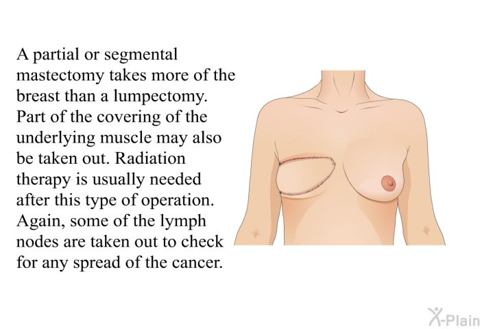 A partial or segmental mastectomy takes more of the breast than a lumpectomy. Part of the covering of the underlying muscle may also be taken out. Radiation therapy is usually needed after this type of operation. Again, some of the lymph nodes are taken out to check for any spread of the cancer.