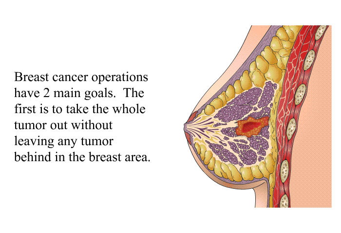 Breast cancer operations have 2 main goals. The first is to take the whole tumor out without leaving any tumor behind in the breast area.