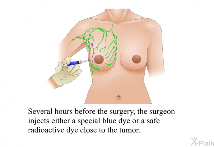 Several hours before the surgery, the surgeon injects either a special blue dye or a safe radioactive dye close to the tumor.