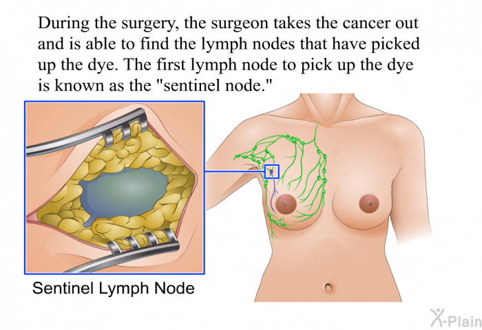 During the surgery, the surgeon takes the cancer out and is able to find the lymph nodes that have picked up the dye. The first lymph node to pick up the dye is known as the "sentinel node."