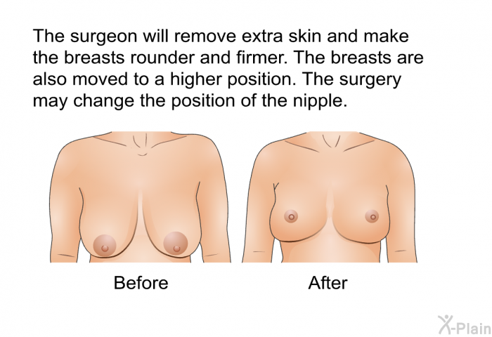 The surgeon will remove extra skin and make the breasts rounder and firmer. The breasts are also moved to a higher position. The surgery may change the position of the nipple.