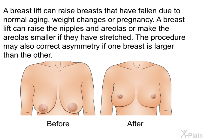 A breast lift can raise breasts that have fallen due to normal aging, weight changes or pregnancy. A breast lift can raise the nipples and areolas or make the areolas smaller if they have stretched. The procedure may also correct asymmetry if one breast is larger than the other.