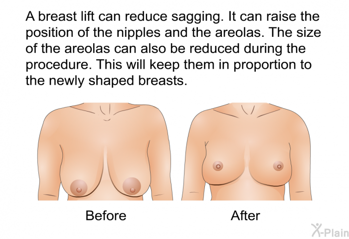 A breast lift can reduce sagging. It can raise the position of the nipples and the areolas. The size of the areolas can also be reduced during the procedure. This will keep them in proportion to the newly shaped breasts.