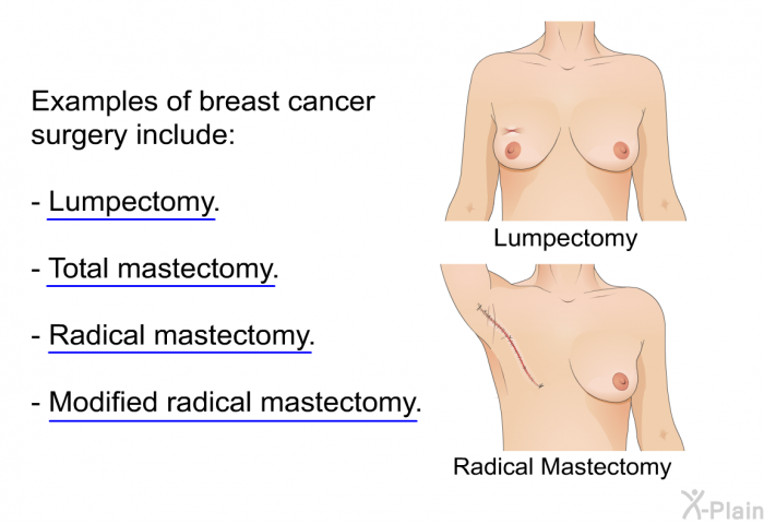Examples of breast cancer surgery include:  Lumpectomy. Total mastectomy. Radical mastectomy. Modified radical mastectomy.