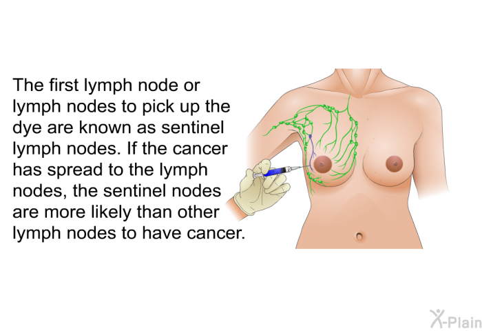 The first lymph node or lymph nodes to pick up the dye are known as sentinel lymph nodes. If the cancer has spread to the lymph nodes, the sentinel nodes are more likely than other lymph nodes to have cancer.