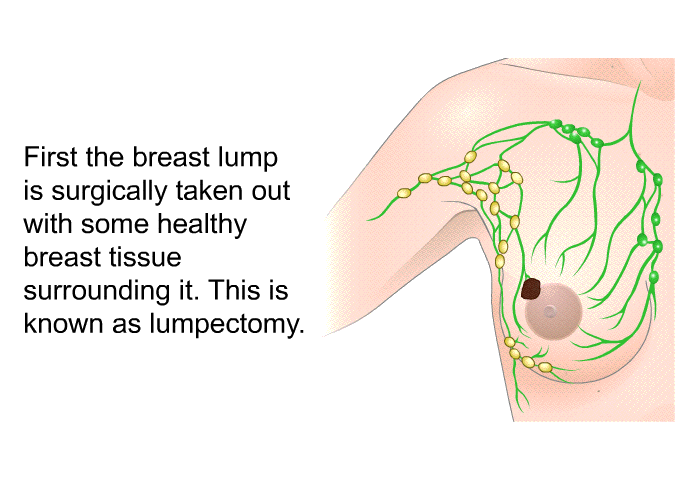 First the breast lump is surgically taken out with some healthy breast tissue surrounding it. This is known as lumpectomy.