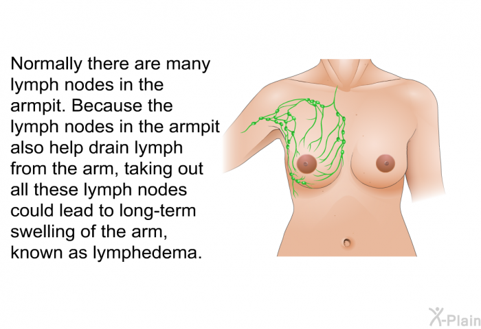 Normally there are many lymph nodes in the armpit. Because the lymph nodes in the armpit also help drain lymph from the arm, taking out all these lymph nodes could lead to long-term swelling of the arm, known as lymphedema.