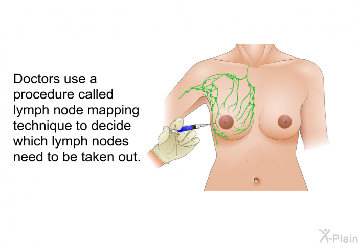 Doctors use a procedure called lymph node mapping technique to decide which lymph nodes need to be taken out.