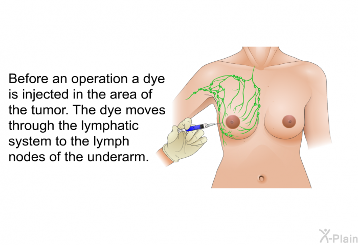 Before an operation a dye is injected in the area of the tumor. The dye moves through the lymphatic system to the lymph nodes of the underarm.