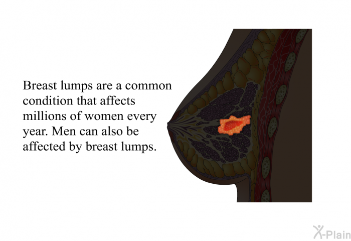 Breast lumps are a common condition that affects millions of women every year. Men can also be affected by breast lumps.