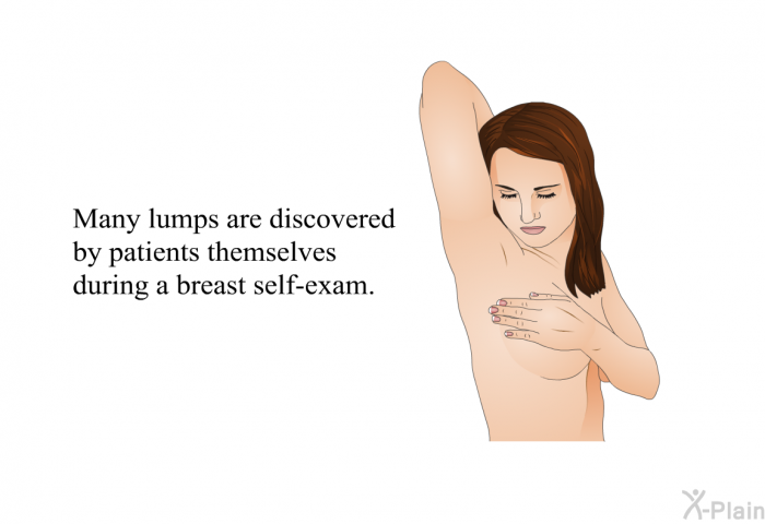 Many lumps are discovered by patients themselves during a breast self-exam.