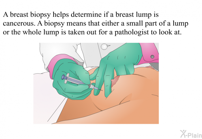 A breast biopsy helps determine if a breast lump is cancerous. A biopsy means that either a small part of a lump or the whole lump is taken out for a pathologist to look at.