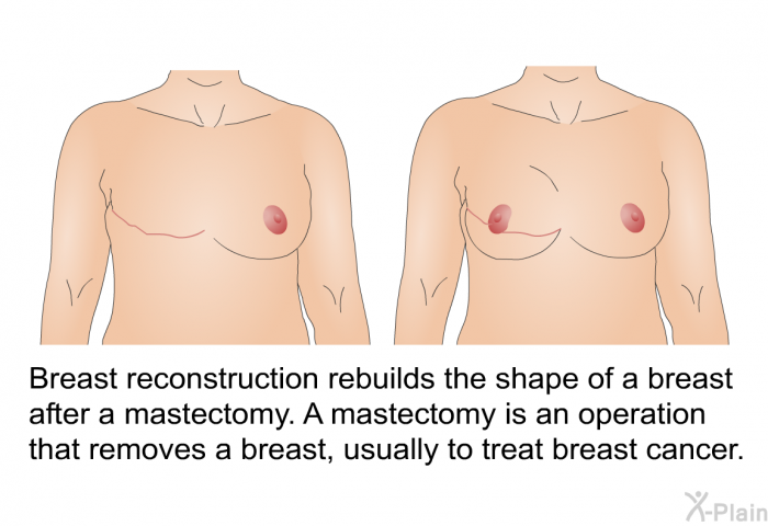 Breast reconstruction rebuilds the shape of a breast after a mastectomy. A mastectomy is an operation that removes a breast, usually to treat breast cancer.