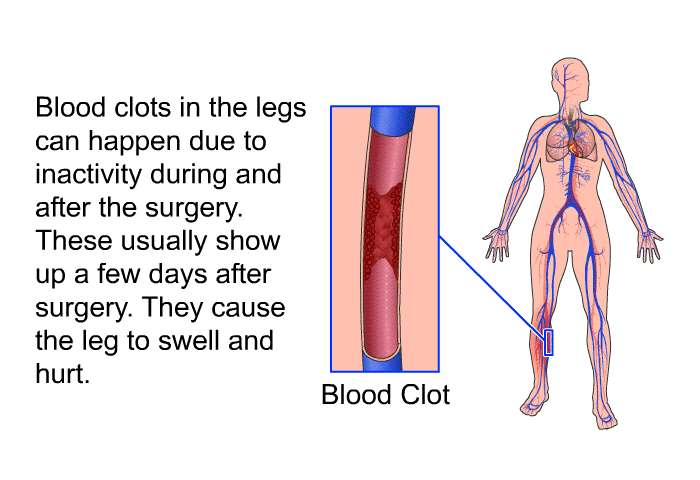 Blood clots in the legs can happen due to inactivity during and after the surgery. These usually show up a few days after surgery. They cause the leg to swell and hurt.