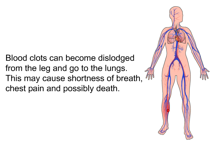 Blood clots can become dislodged from the leg and go to the lungs. This may cause shortness of breath, chest pain and possibly death.