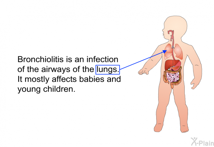 Bronchiolitis is an infection of the airways of the lungs. It mostly affects babies and young children.