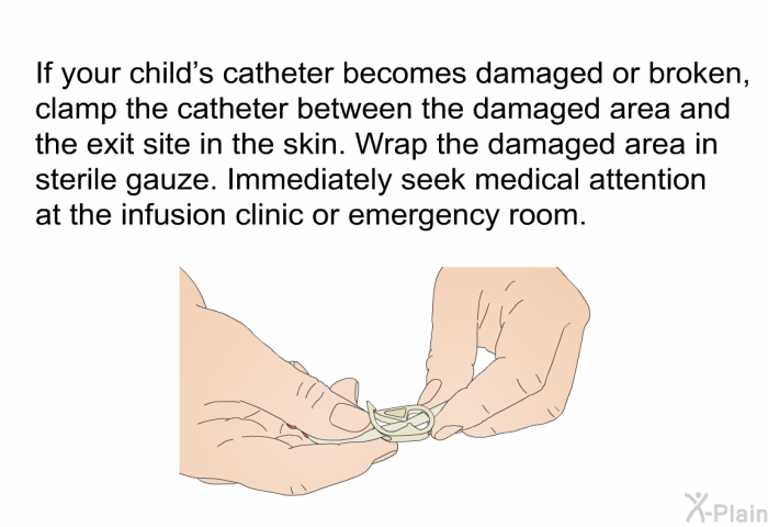 If your child's catheter becomes damaged or broken, clamp the catheter between the damaged area and the exit site in the skin. Wrap the damaged area in sterile gauze. Immediately seek medical attention at the infusion clinic or emergency room.