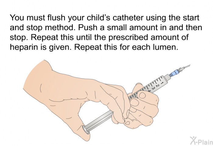 You must flush your child's catheter using the start and stop method. Push a small amount in and then stop. Repeat this until the prescribed amount of heparin is given. Repeat this for each lumen.