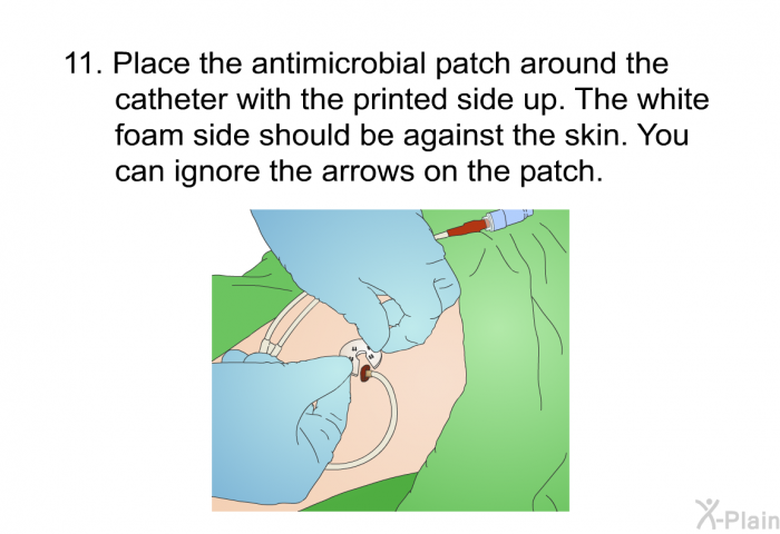 Place the antimicrobial patch around the catheter with the printed side up. The white foam side should be against the skin. You can ignore the arrows on the patch.