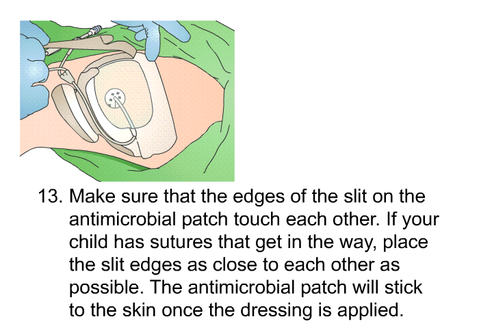 <OL START=13> Make sure that the edges of the slit on the antimicrobial patch touch each other. If your child has sutures that get in the way, place the slit edges as close to each other as possible. The antimicrobial patch will stick to the skin once the dressing is applied.
