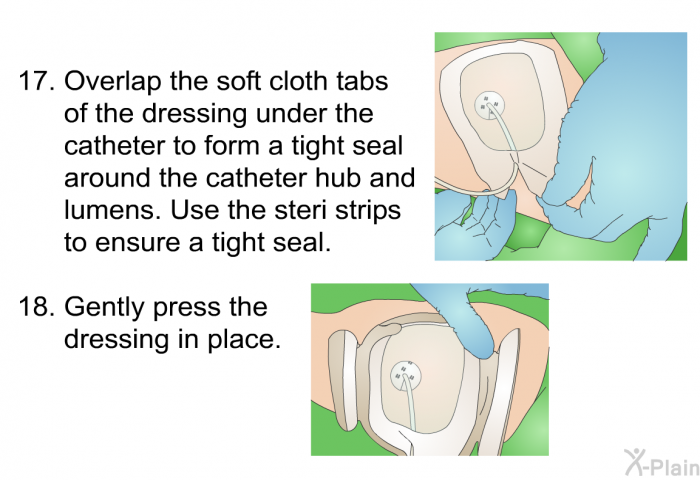 <OL START=17> Overlap the soft cloth tabs of the dressing under the catheter to form a tight seal around the catheter hub and lumens. Use the steri strips to ensure a tight seal. Gently press the dressing in place.