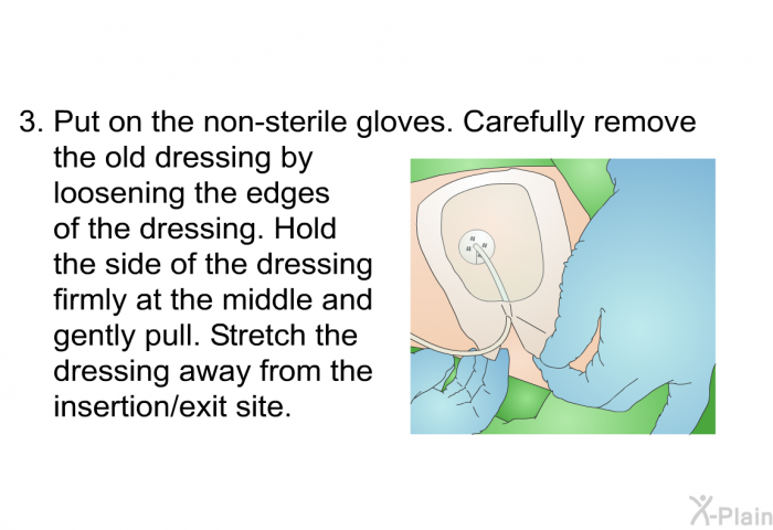 Put on the non-sterile gloves. Carefully remove the old dressing by loosening the edges of the dressing. Hold the side of the dressing firmly at the middle and gently pull. Stretch the dressing away from the insertion/exit site.