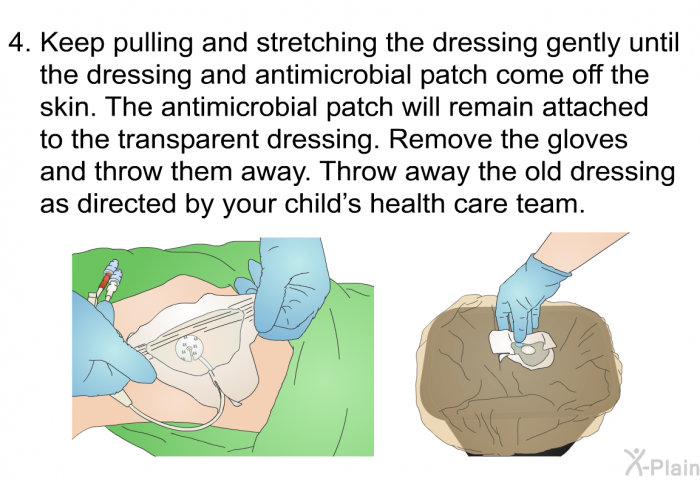 Keep pulling and stretching the dressing gently until the dressing and antimicrobial patch come off the skin. The antimicrobial patch will remain attached to the transparent dressing. Remove the gloves and throw them away. Throw away the old dressing as directed by your child’s health care team.