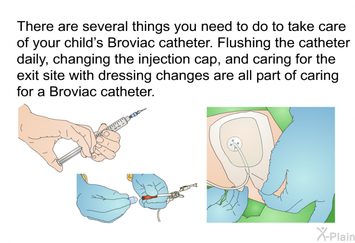 There are several things you need to do to take care of your child's Broviac catheter. Flushing the catheter daily, changing the injection cap, and caring for the exit site with dressing changes are all part of caring for a Broviac catheter.
