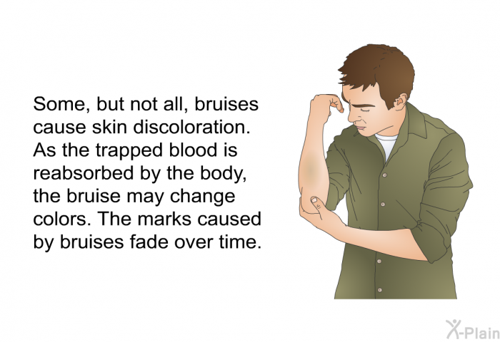 Some, but not all, bruises cause skin discoloration. As the trapped blood is reabsorbed by the body, the bruise may change colors. The marks caused by bruises fade over time.