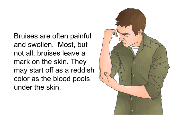 Bruises are often painful and swollen. Most, but not all, bruises leave a mark on the skin. They may start off as a reddish color as the blood pools under the skin.