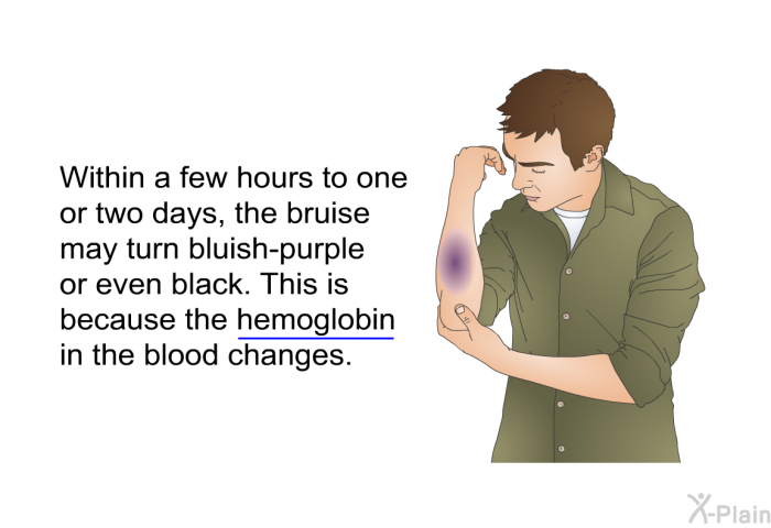 Within a few hours to one or two days, the bruise may turn bluish-purple or even black. This is because the hemoglobin in the blood changes.