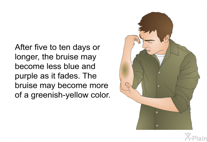 After five to ten days or longer, the bruise may become less blue and purple as it fades. The bruise may become more of a greenish-yellow color.