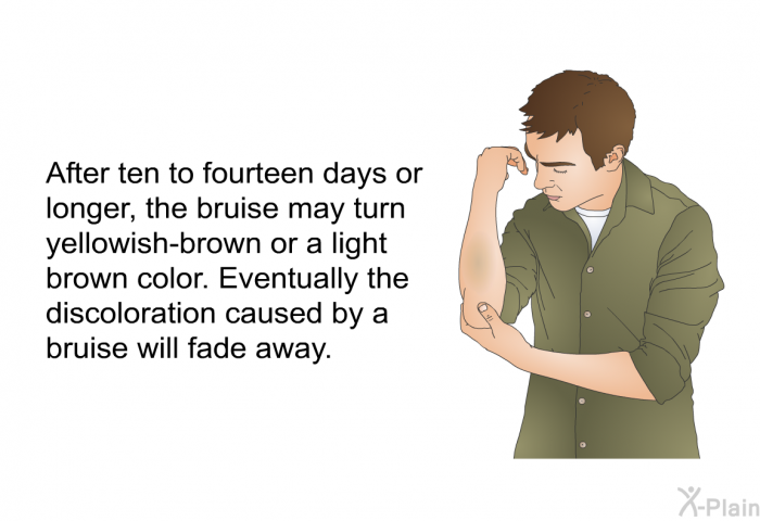 After ten to fourteen days or longer, the bruise may turn yellowish-brown or a light brown color. Eventually the discoloration caused by a bruise will fade away.