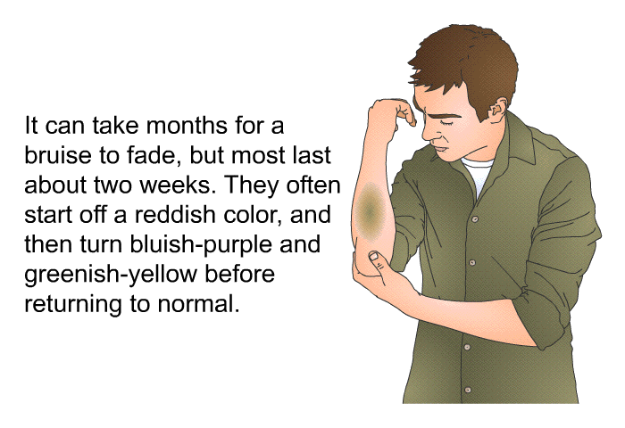 It can take months for a bruise to fade, but most last about two weeks. They often start off a reddish color, and then turn bluish-purple and greenish-yellow before returning to normal.