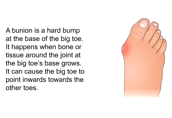 A bunion is a hard bump at the base of the big toe. It happens when bone or tissue around the joint at the big toe's base grows. It can cause the big toe to point inwards towards the other toes.