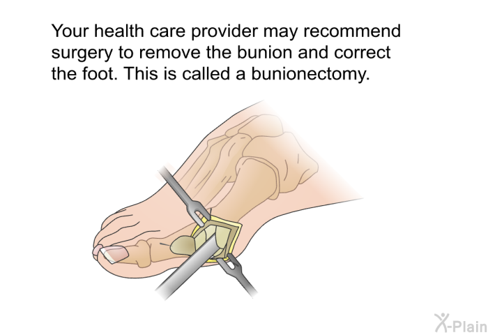 Your health care provider may recommend surgery to remove the bunion and correct the foot. This is called a bunionectomy.