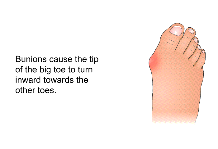 Bunions cause the tip of the big toe to turn inward towards the other toes.