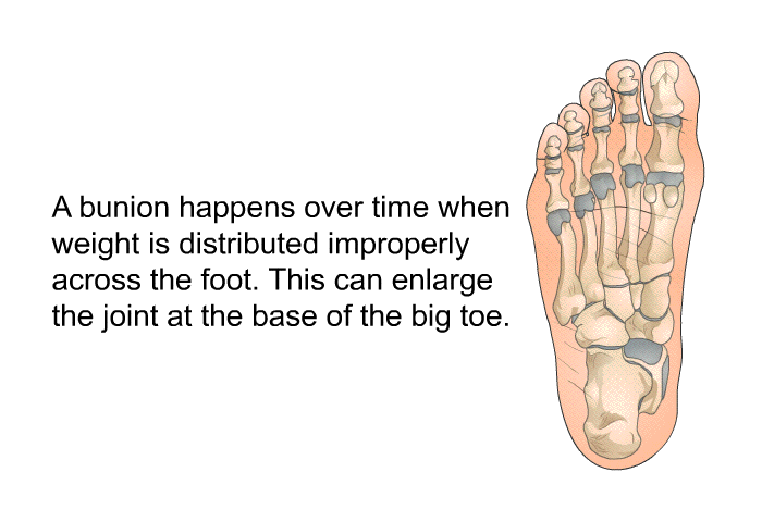 A bunion happens over time when weight is distributed improperly across the foot. This can enlarge the joint at the base of the big toe.