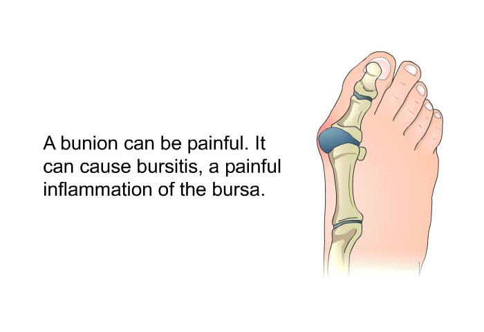 A bunion can be painful. It can cause bursitis, a painful inflammation of the bursa.
