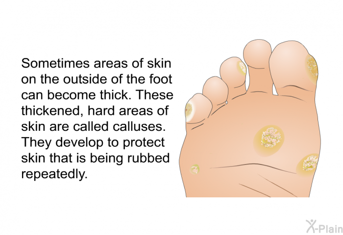 Sometimes areas of skin on the outside of the foot can become thick. These thickened, hard areas of skin are called calluses. They develop to protect skin that is being rubbed repeatedly.