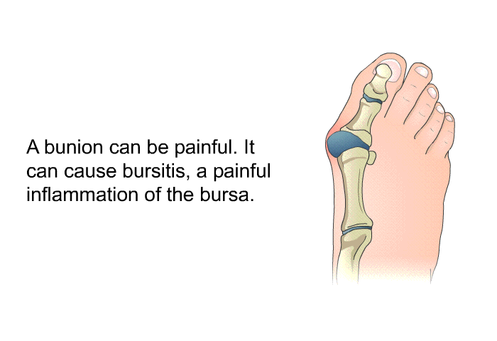 A bunion can be painful. It can cause bursitis, a painful inflammation of the bursa.