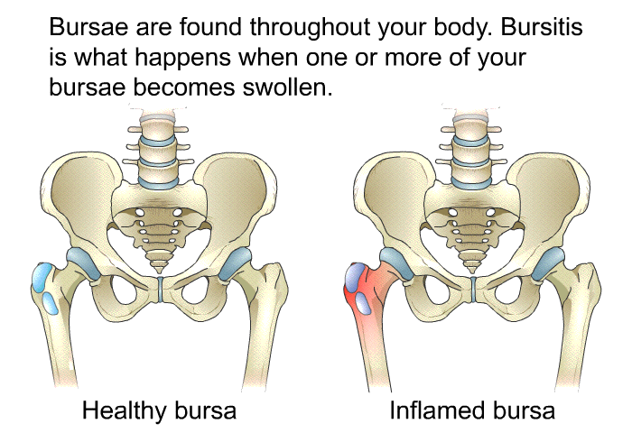 Bursae are found throughout your body. Bursitis is what happens when one or more of your bursae becomes swollen.