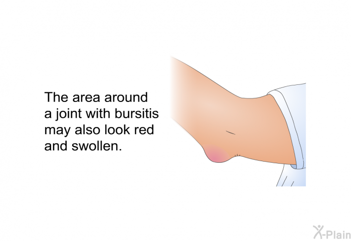 The area around a joint with bursitis may also look red and swollen.