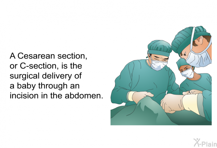 A Cesarean section, or C-section, is the surgical delivery of a baby through an incision in the abdomen.