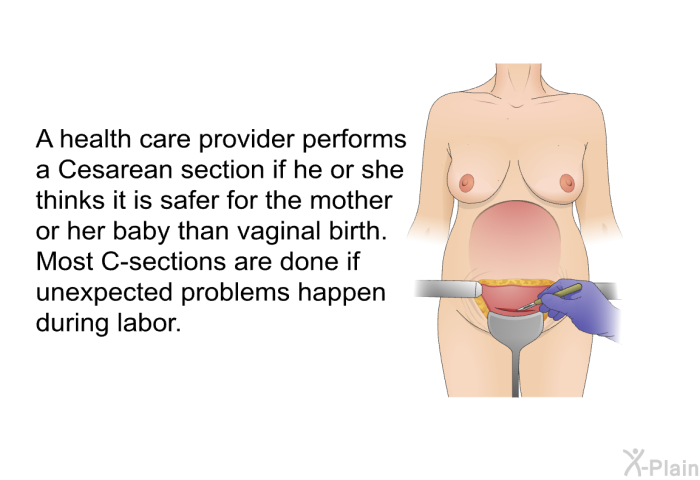 A health care provider performs a Cesarean section<SUP> </SUP>if he or she thinks it is safer for the mother or her baby than vaginal birth. Most C-sections are done if unexpected problems happen during labor.